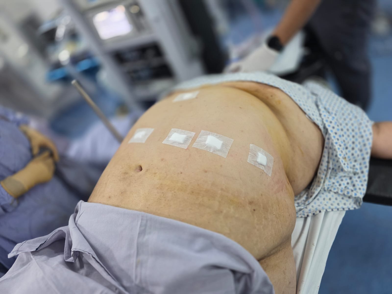 Abdomen con apósitos después de una cirugía laparoscópica