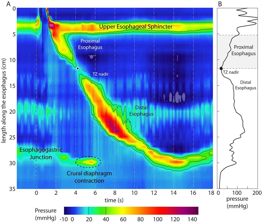 Ejemplo educativo de una topografía de presión de manometría esofágica