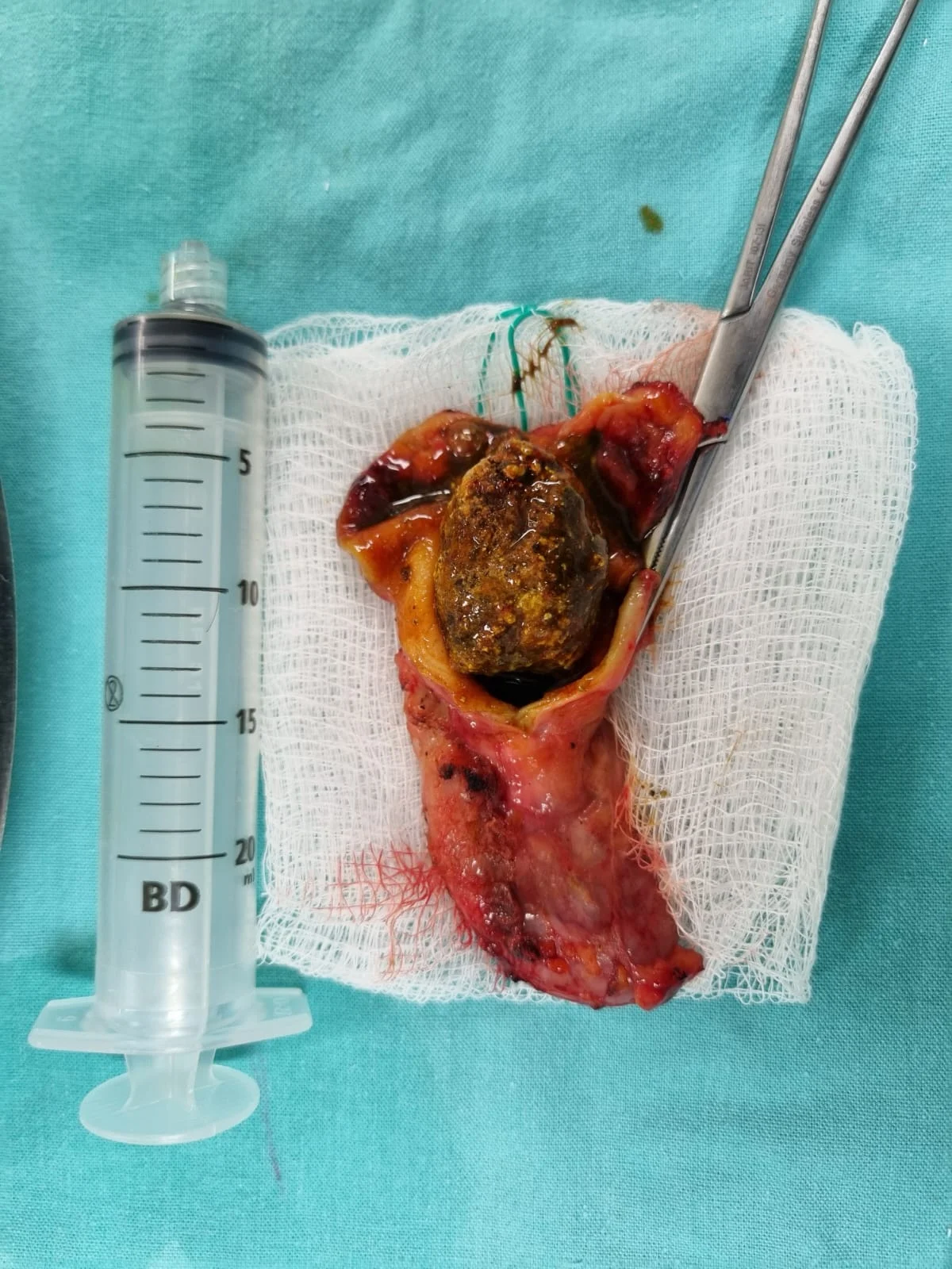 Pieza quirúrgica de vesícula biliar con un cálculo