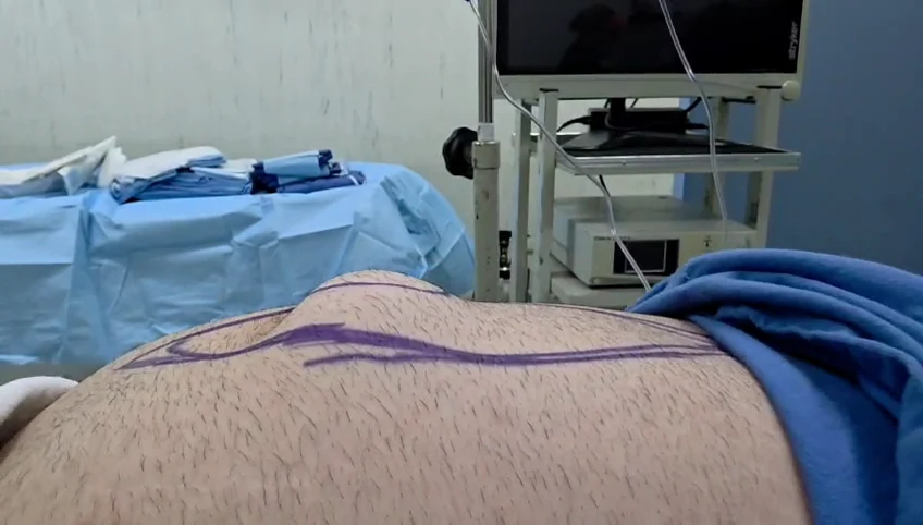 Captura clínica de una hernia de la pared abdominal