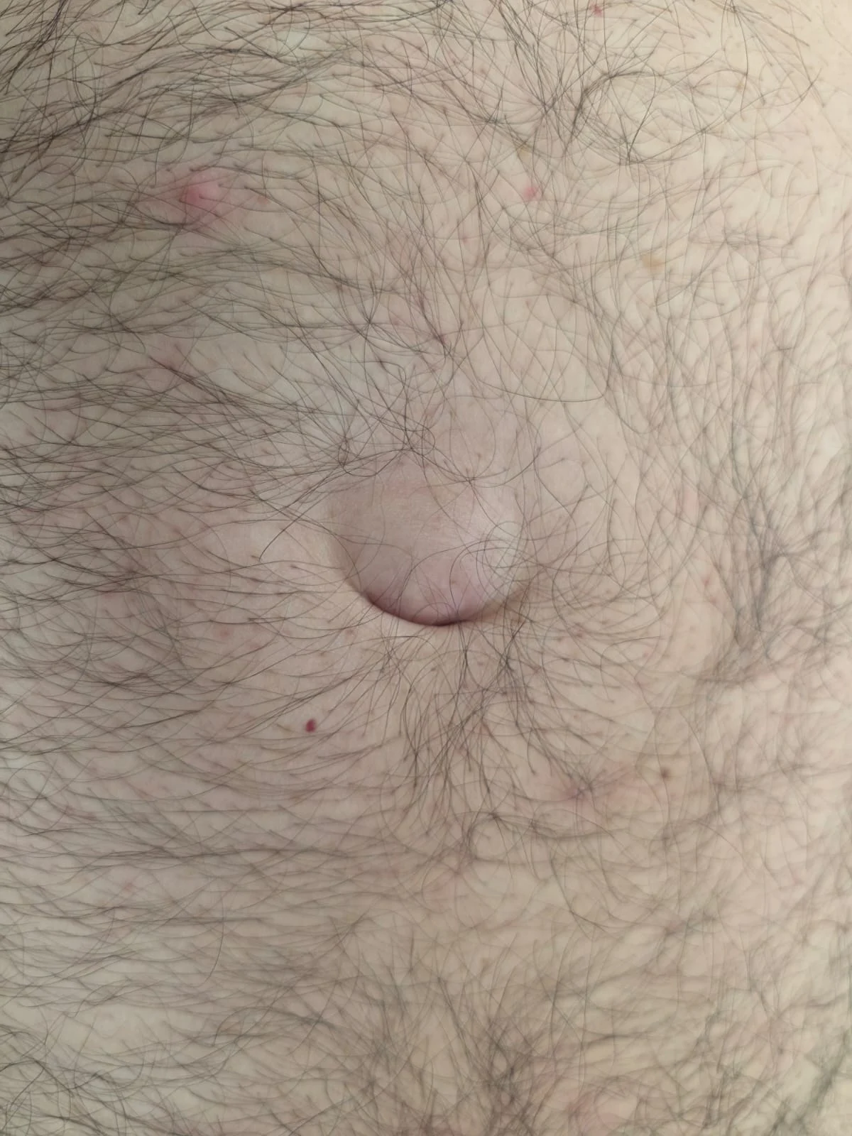 Fotografía clínica de una hernia umbilical